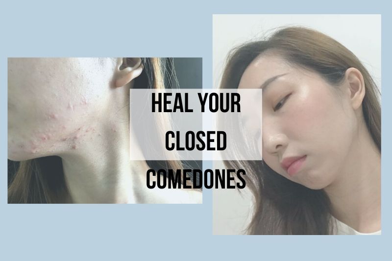 How To Get Rid Of Closed Comedones Overnight I Know Its Not Always
