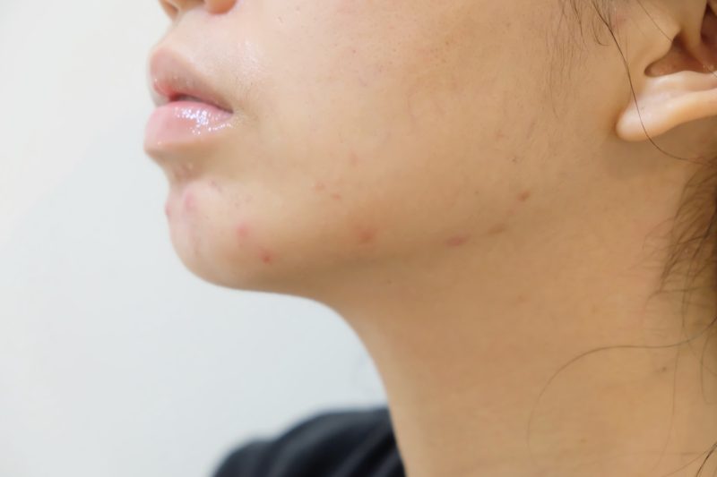 How I Got Rid Of My Closed Comedones Small Bumps On My Jawline Dry 